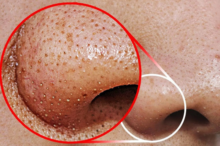 Its effectiveness in the problem of blackheads