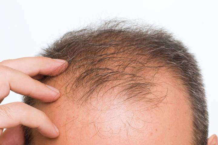 bald men at higher risk of severe case of covid-19 finds researcher