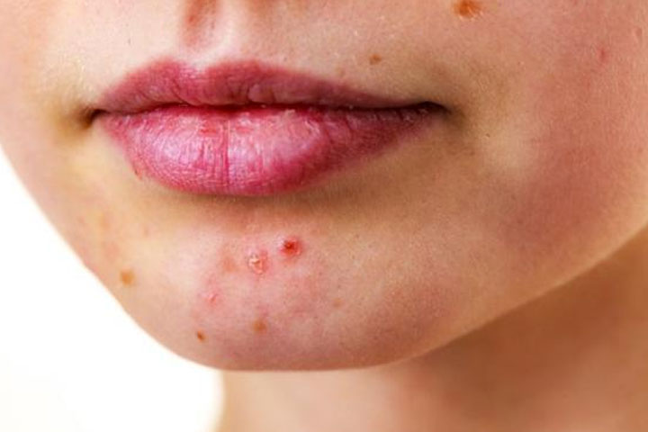 With so many things at this time we are also worried about acne