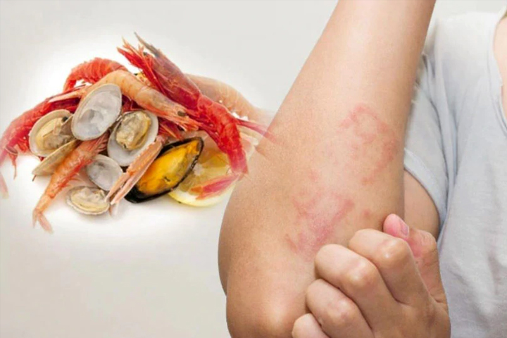 Sea food and allergies. Symbolic image.