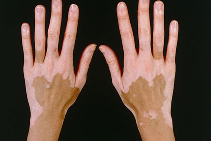 Albinism disease hand