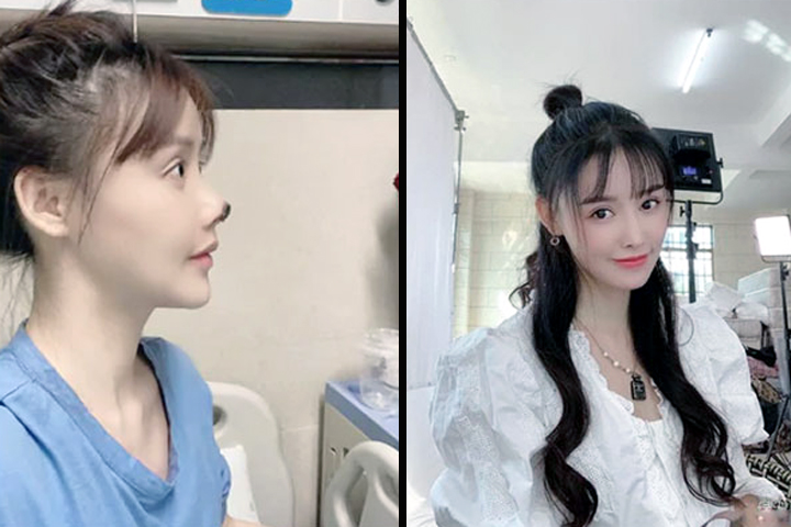 Chinese actress shares photos of her botched nose surgery