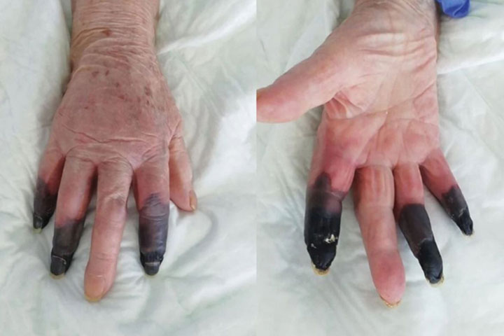 COVID-19 infected woman's fingers turned black