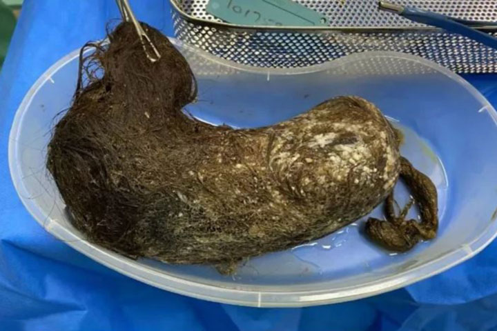 doctors remove 48 cm hairball from stomach of uk teen