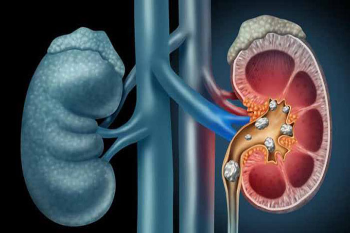 How to understand if you have kidney stones?