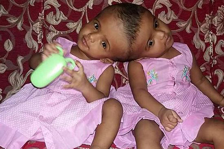 Why are twins and what is the treatment?